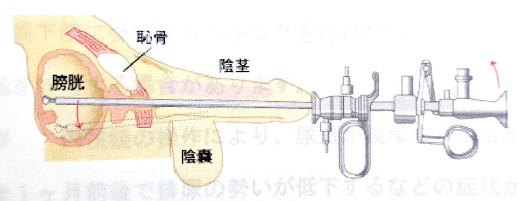 カテーテル手術